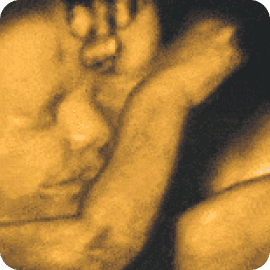 3d ultra sound