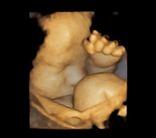 Prenatal ultrasound scan showing a sleeping baby in the womb