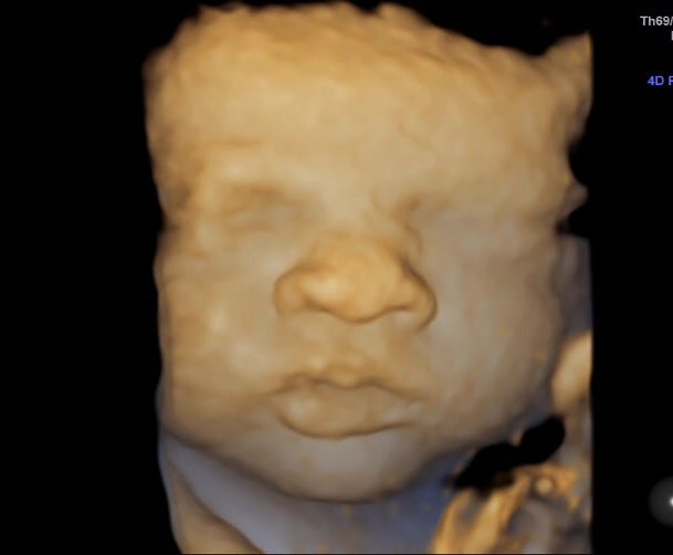 An ultrasound