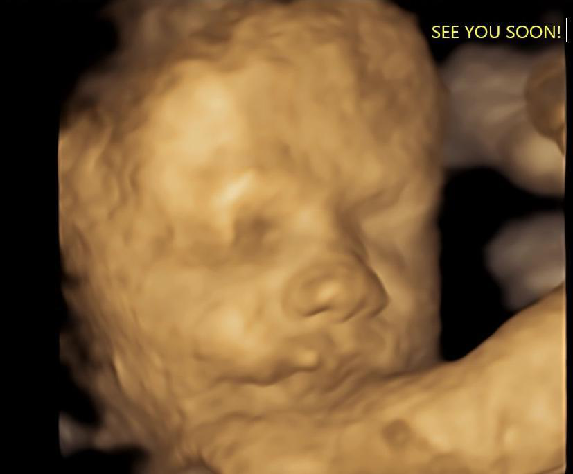 A baby in an ultrasound