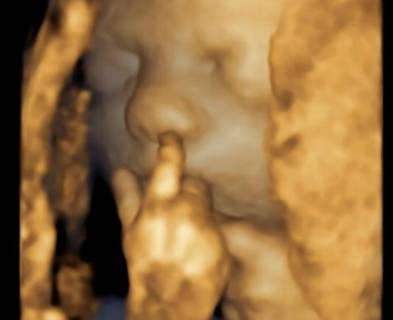 An ultrasound