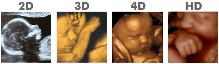 2d ultrasound, 3d ultrasound, 4d ultrasound and hd ultrasound images comparison photo